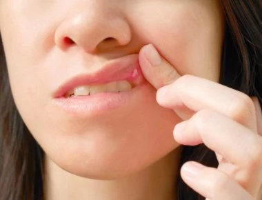 Άφθες ή άφτρες στο στόμα: Ποια είναι η σωστή αντιμετώπιση